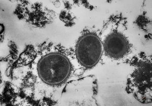 M,57y. | necrotizing pneumonia … unidentified microbes